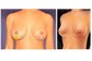 Reconstrução Mamária